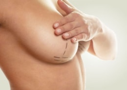 Mamoplastia de Redução em Goiânia