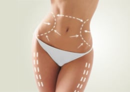 Lipoaspiração em Goiânia