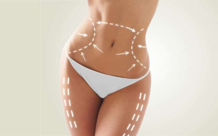 Lipoaspiração em Goiânia Lipoaspiração em Goiânia